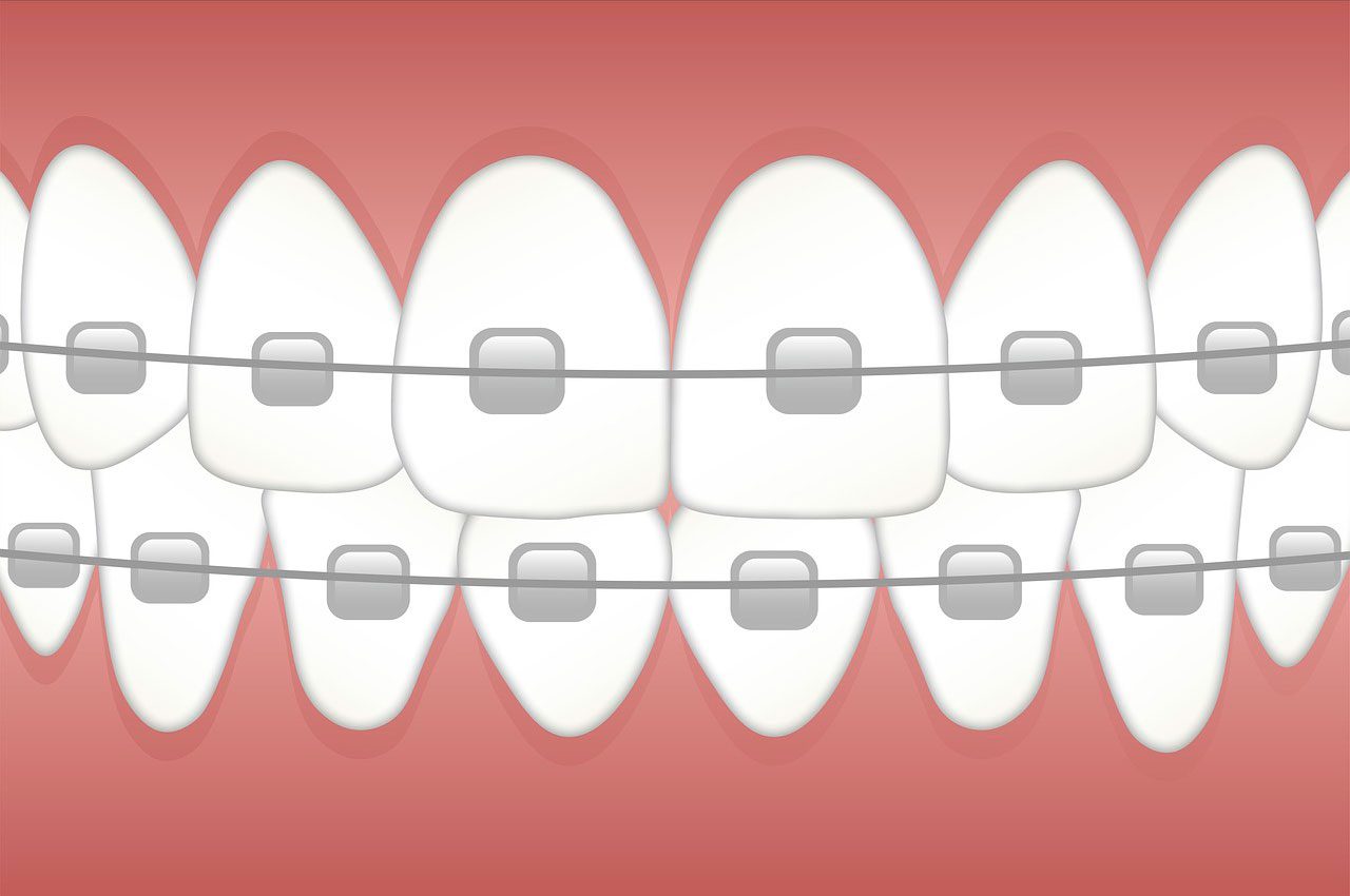 Brackets